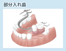 部分入れ歯