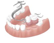部分入れ歯
